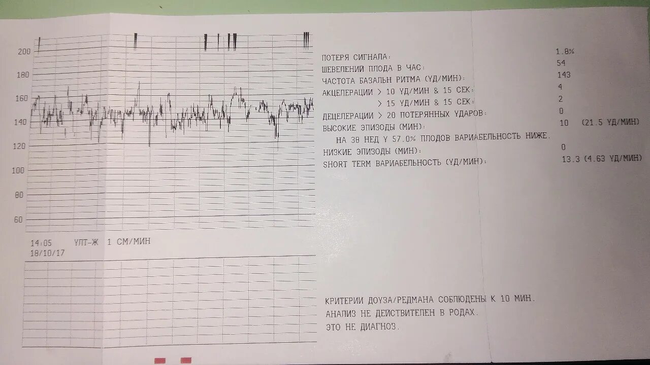 Шевеления плода ощущения. Short term вариабельность КТГ норма. Шорт Терм вариабельность КТГ норма. КТГ при беременности показатели вариабельность. Вариабельность КТГ норма 34.
