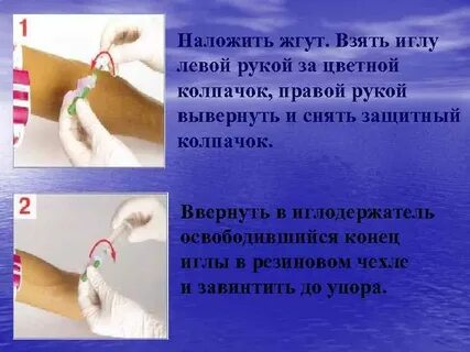 Признак правильно наложенного жгута