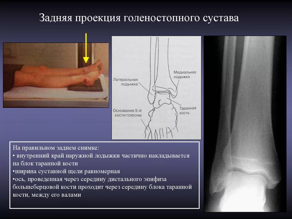 Описание голеностопного сустава. Голеностопный сустав в боковой проекции. Наружная лодыжка большеберцовой кости. Рентгенография голеностопного сустава в боковой проекции. Рентген голеностопного сустава в боковой проекции.