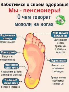 Говорю о мозоли