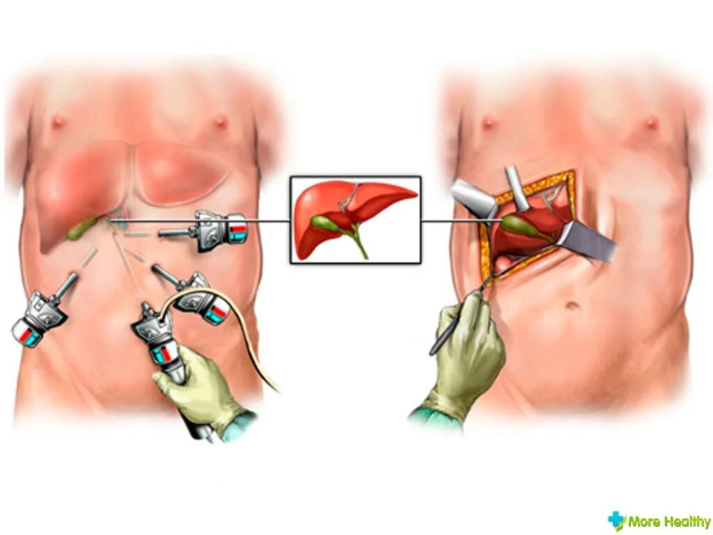 Как делается операция желчного пузыря. Как делается операция желчного пузыря. Лапароскопическая холецистэктомия дренирование брюшной полости. Как делается операция желчного пузыря. Лапаротомия холецистэктомия.
