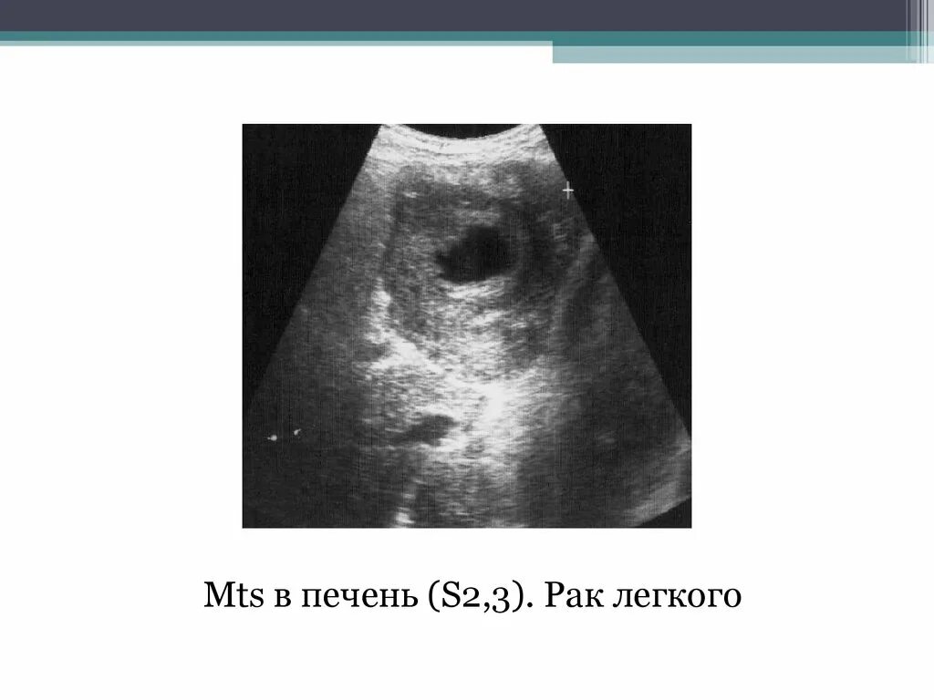 Множественные образования в печени. Множественные метастазы в печени УЗИ.