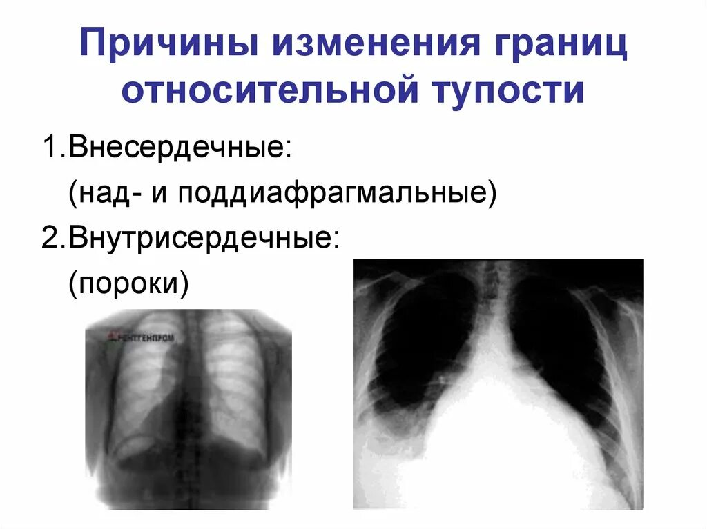 Причины изменения границ. Изменения границ относительной тупости. Патологические формы грудной клетки. Внесердечные причины, вызывающие изменения границ сердца. Внесердечные причины изменения абсолютной тупости.