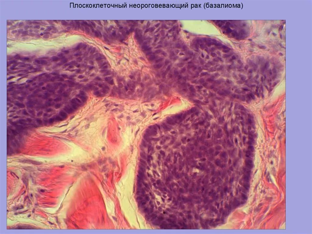 Фиброзирующая базалиома. Базалиома патанатомия. Опухолевидная базалиома. Плоскоклеточный неороговевающий рак шейки