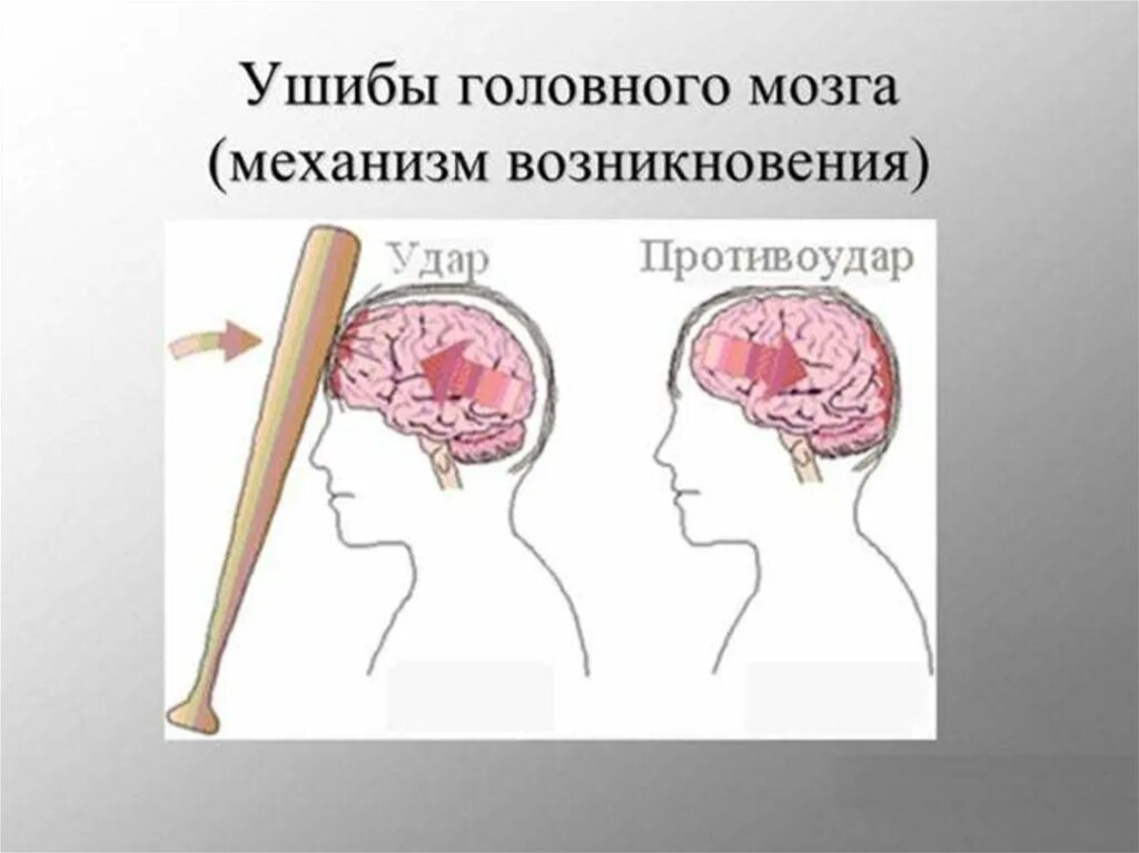 Удар головой признаки сотрясения. Черепно-мозговая травма удар противоудар. Ушиб головного мозга симптомы 1 степени. Клинические проявления ушиба головного мозга легкой степени. Повреждения головы и головного мозга..