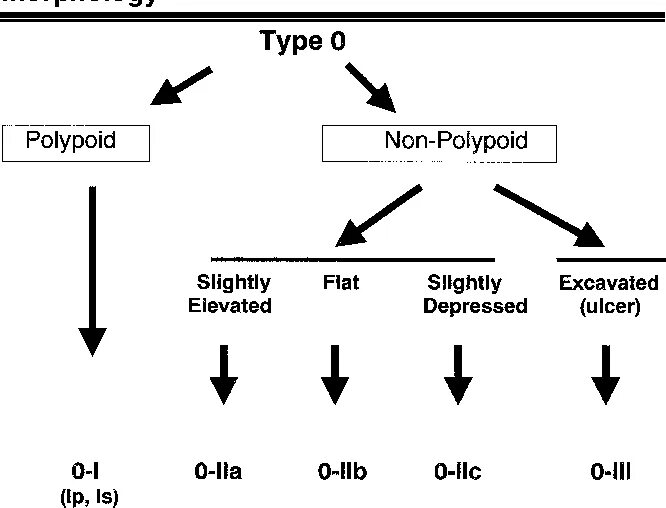 Тип 0 is. Парижская классификация эпителиальных. Парижская классификация полипов. Парижская классификация полипов желудка эндоскопическая. Парижская классификация опухолевых поражений.