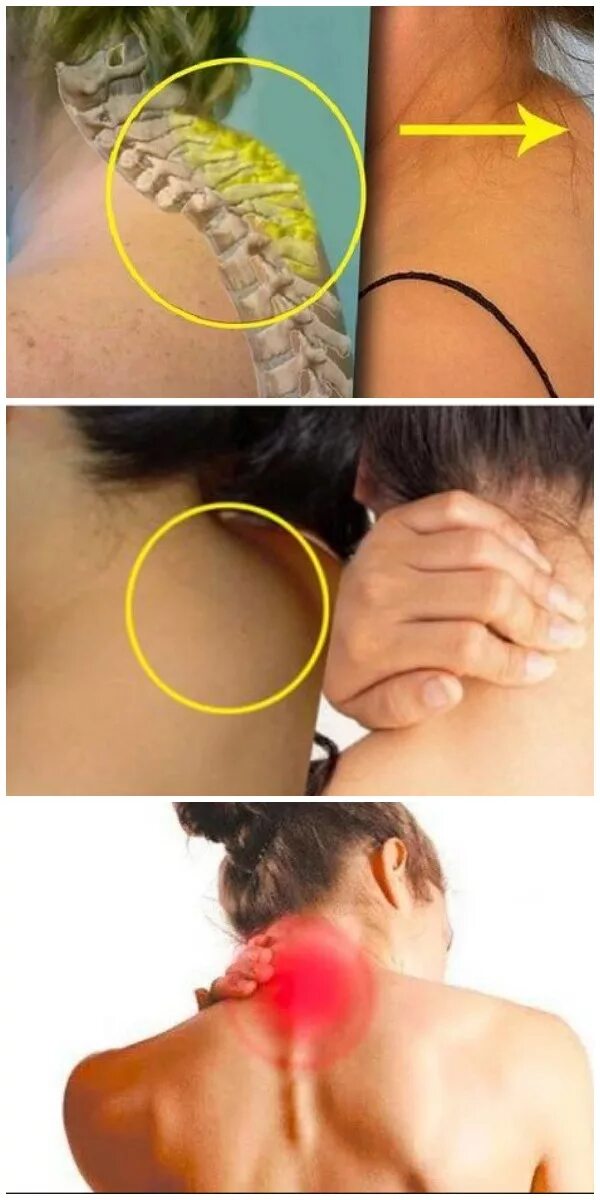 Климактерический горбик. Вдовья холка как избавиться. Остеопороз вдовий горбик. Вдовья холка как избавиться. Отложение солей вдовий горб.