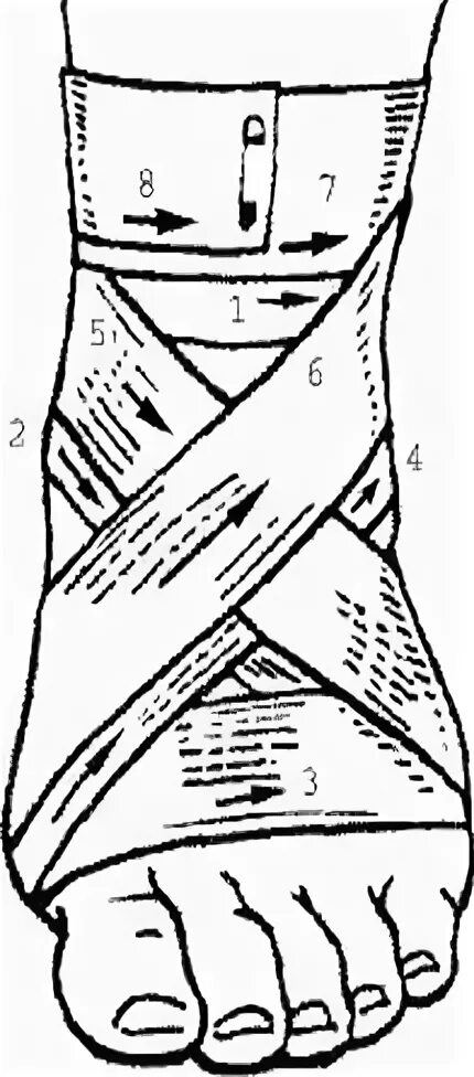 Крестообразная повязка на голеностопный сустав алгоритм. Восьмиобразная бинтовая повязка. Восьмиобразная повязка на голеностоп техника. Наложение крестообразной повязки на голеностопный сустав.