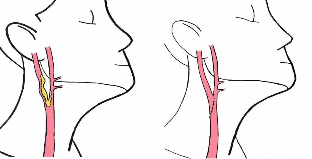 Стеноз наружной сонной артерии. Бляшка на шее операция