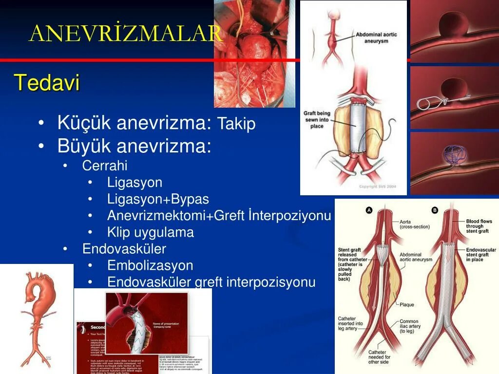 Аневризма стент. Аневризма брюшной артерии. Эндоваскулярная хирургия аневризм артерий головного мозга.