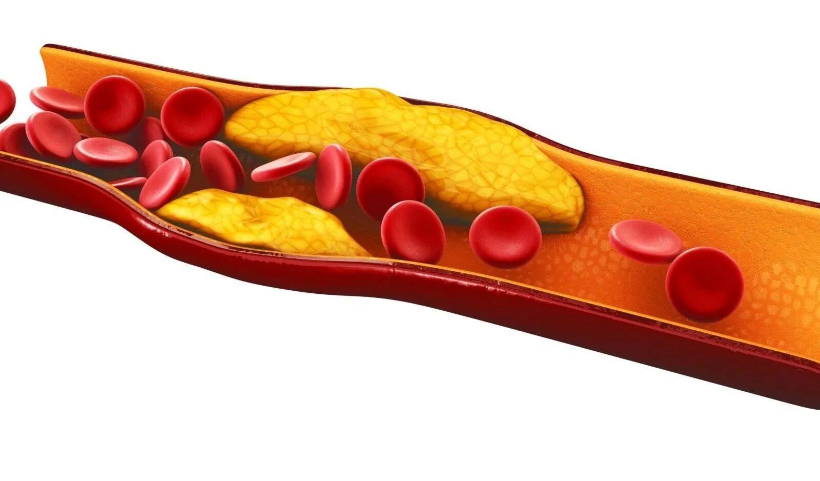 Уменьшение холестерина в крови. Атеросклеротические бляшки в сосудах. Атеросклеротические бляшки в сосудах образуются. Повышенный уровень холестерина.