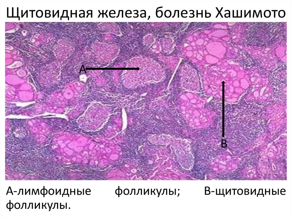 Лимфоцитарная инфильтрация гистология. Инфильтрация щитовидной железы. Тиреоидит риделя гистология. Макропрепарат тиреоидит хашимото. Фиброзный тиреоидит гистология.