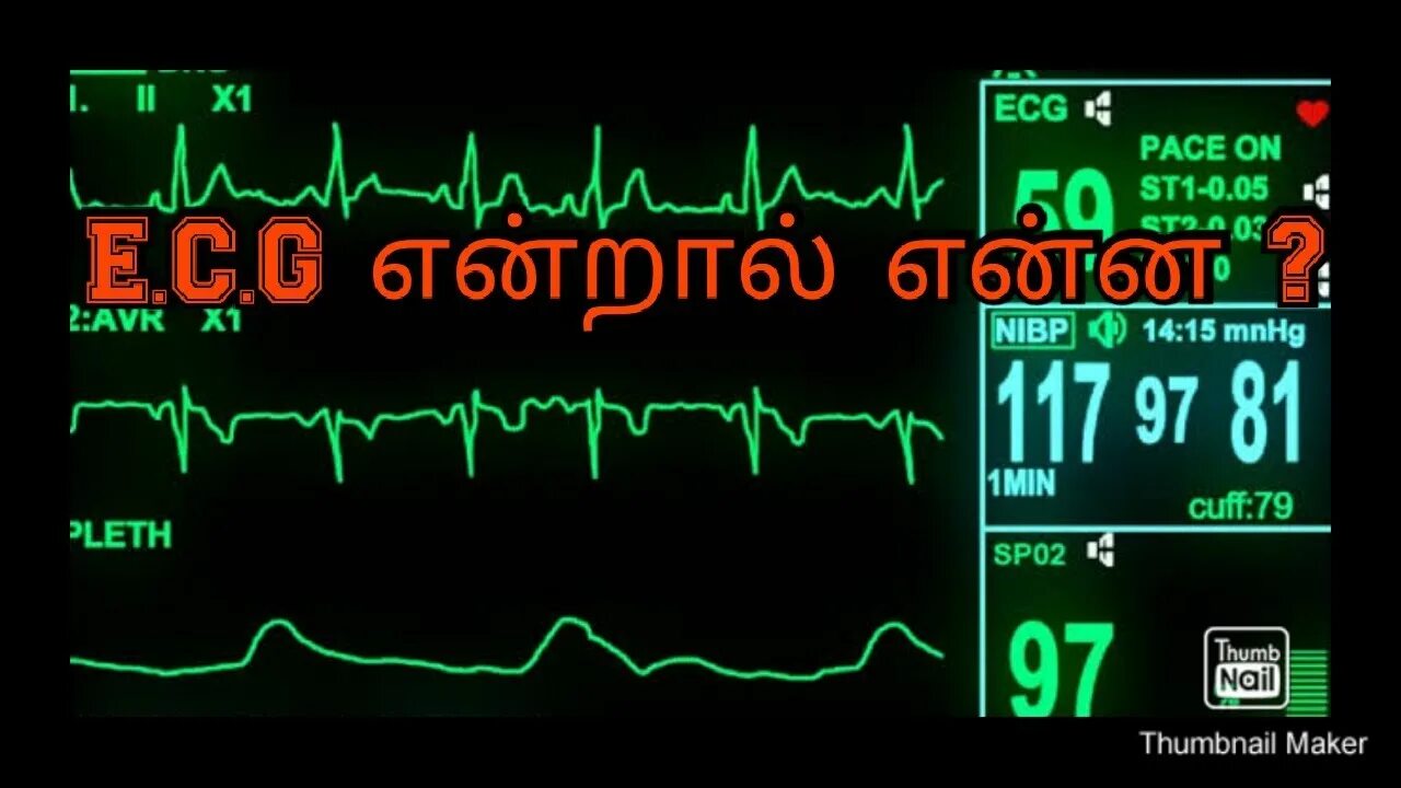 Прибор показывающий кардиограмму. Кардиостимулятор сердца. Электрическая кардиоверсия (дефибрилляция сердца). Дефибриллятор в машине скорой. Монитор пациента в больнице.