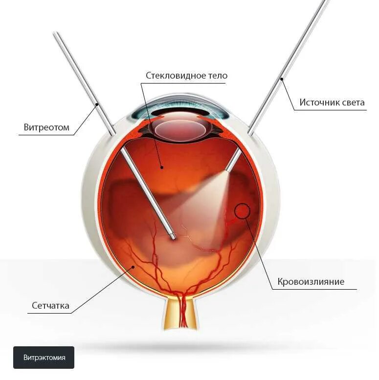 Отслойка сетчатки витрэктомия. Витреоретинальная операция сетчатки глаза. Витрэктомия глаза ход операции. Стекловидное тело операция