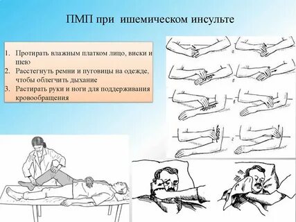 Помощь при ишемическом инсульте