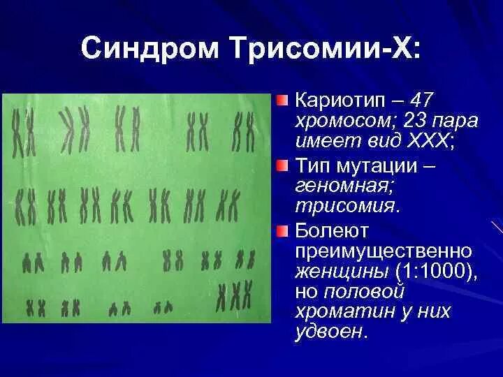 Синдром трисомия кариотип. Синдром Дауна (трисомия по 21 паре хромосом) клиника. Синдром трисомии кариотип 47. Синдром Марфана кариотип.