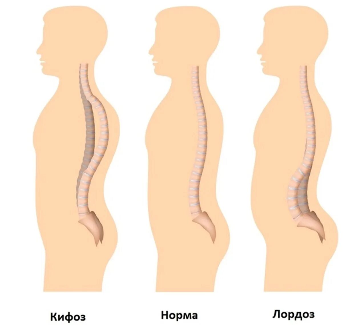Искривление позвоночника лордоз. Гиперлордоз и кифоз грудного отдела позвоночника. Лордоз поясничного отдела позвоночника норма. Искривление позвоночника гиперлордоз.
