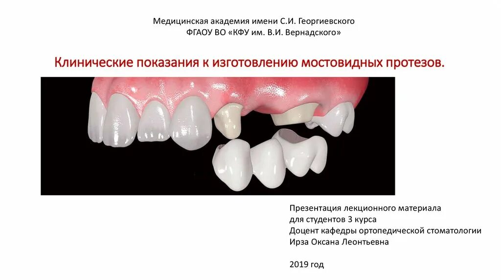 Противопоказания к изготовлению коронки. Противопоказания штампованно-паянных мостовидных протезов. Несъемный мостовидный протез показания. Мостовидные протезы ортопедическая стоматология презентация. Показания к изготовлению мостовидных протезов.