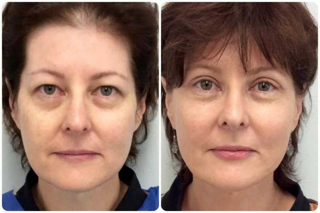 Лазерная блефаропластика грыжи нижних век. Лазерная шлифовка под глазами. Лазерная наноперфорация век блефаропластика. Мешки под глазами до и после операции. Блефаропластика нижних век грыжи.