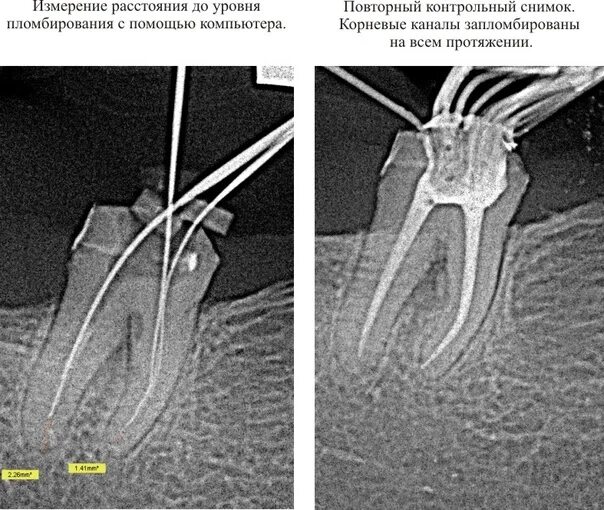 Пломбирование корневых каналов рентген. Пломбировка каналов зуба. Пломбировка корневых каналов