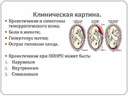 Признаки отслойки при беременности