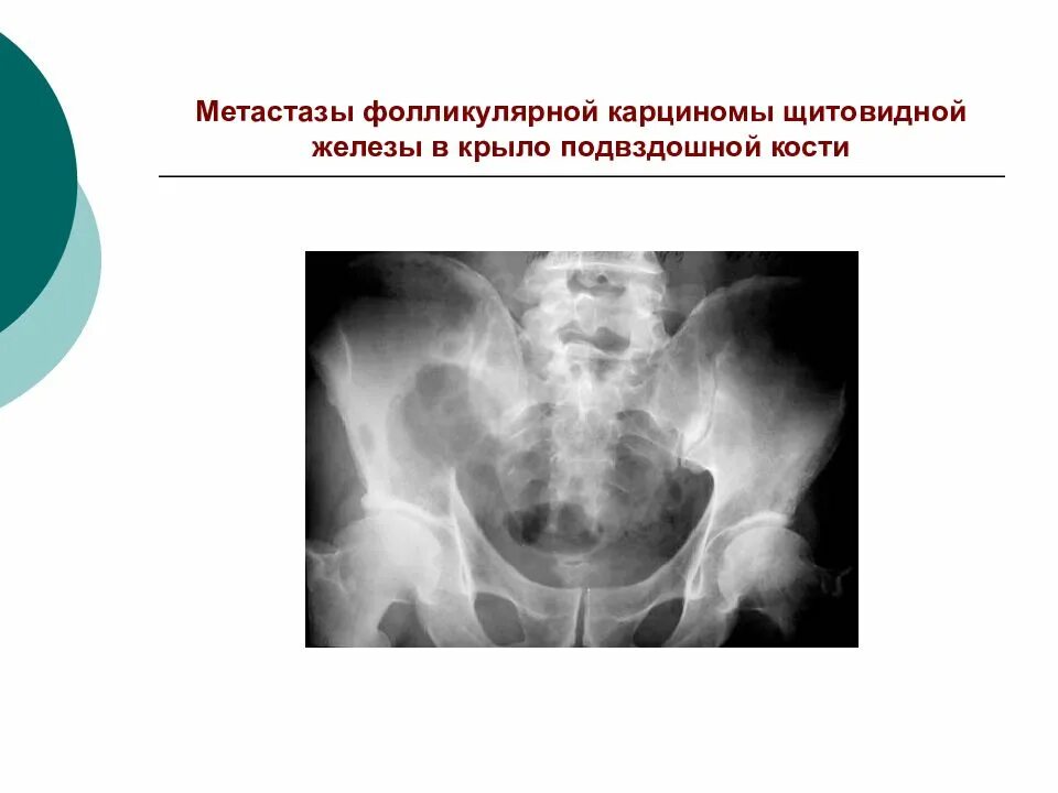 Метастазы щитовидной железы в легкие. Метастазы щитовидной железы в кости. метастазы щитовидной железы. метастазы опухоли щитовидной железы. метастазирование щитовидной железы.