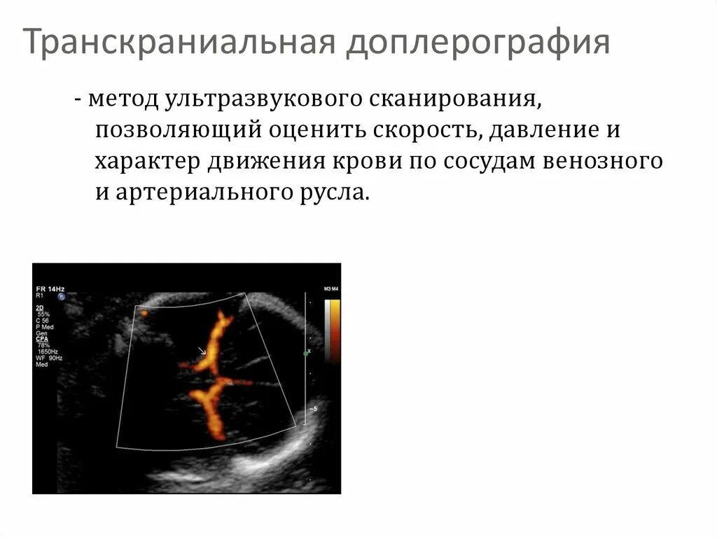 Транскраниальных артерий и вен. Транскраниальное ультразвуковое сканирование головного мозга. Транскраниальная доплерография. Транскраниальное дуплексное сканирование сосудов головного мозга. Дуплексное сканирование транскраниальное артерий и вен.