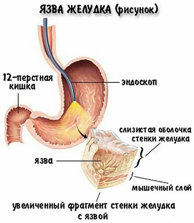 Язва желудка терапия. Язвенная болезнь 12 перстной кишки. Язвенная болезнь желудка и 12 перстной.