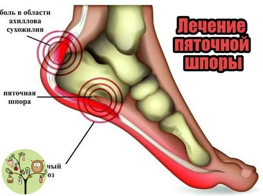 Можно ли вылечить пяточную шпору