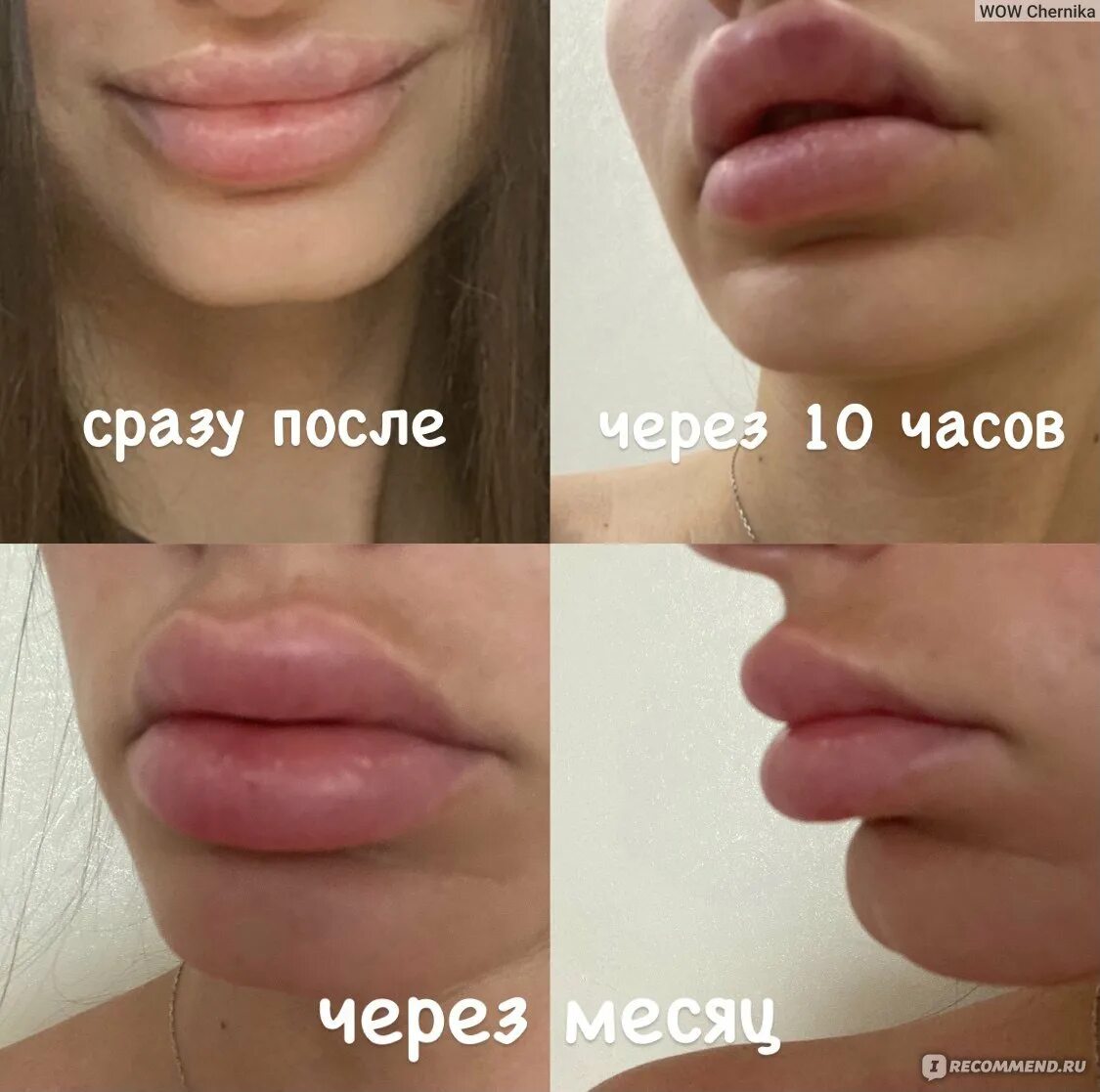 Как разминать филлер