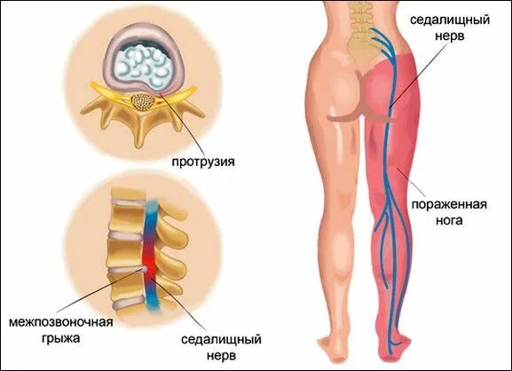 Ишиас воспаление седалищного. Седалищный нерв и грыжа l5 s1. Воспаление седалищного нерва.