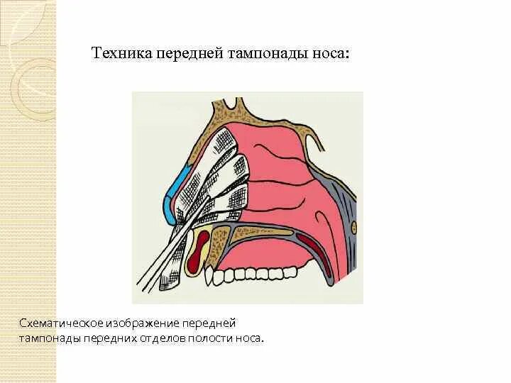 Носовое кровотечение передняя тампонада. Передняя тампонада носа. Передняя и задняя тампонада носа. Передняя тампонада носовых ходов.