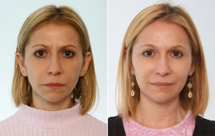 Липофилинг лица до и после Липофилинг лица в Новосибирске по выгодной цене в клинике АвисМед