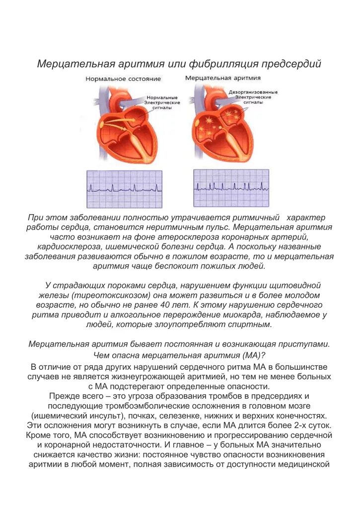 Рча предсердий. РЧА при мерцательной аритмии. Фибрилляция предсердий или Мерцательная аритмия. Трепетание предсердий абляция. Прижигание предсердия сердца.