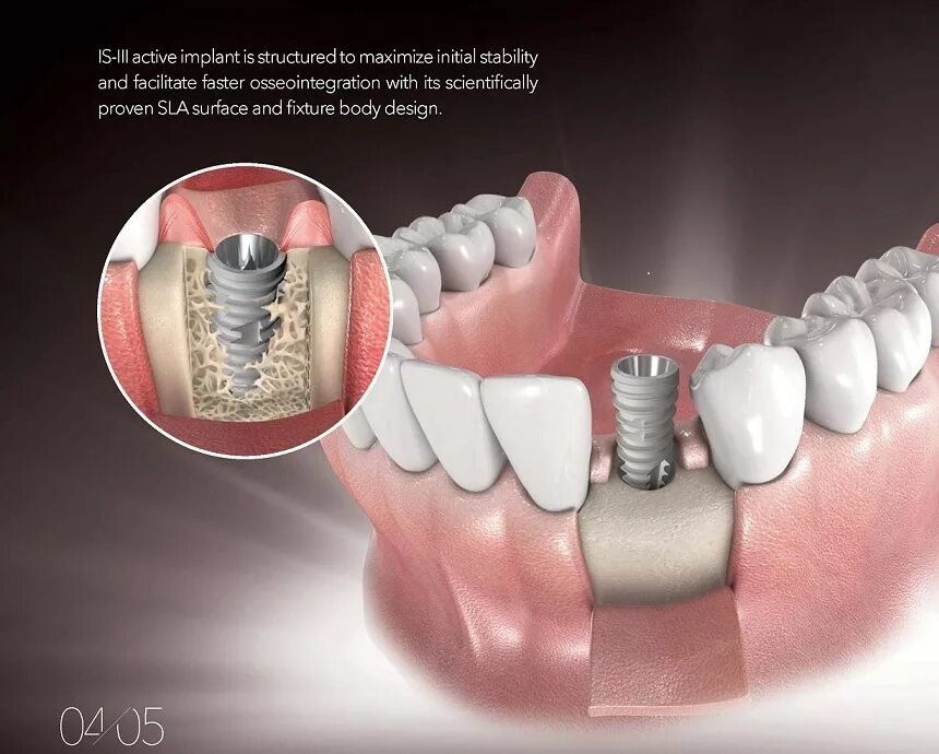 Корейские имплантаты Osstem. Зубной имплант Osstem. Имплантация формирователь Osstem. Имплант Osstem Южная Корея. Имплантация sup aznona com