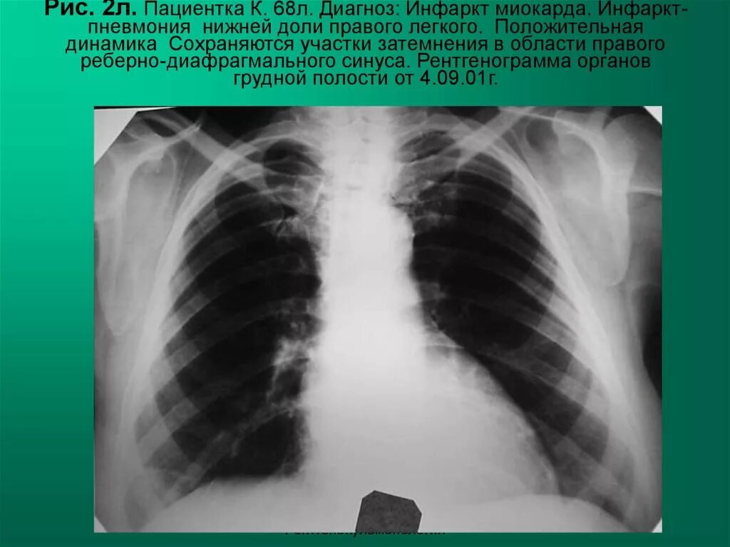 Инфаркт пневмония рентген. Инфаркт пневмония на рентгенограмме. Плевральные наслоения. Пневмония в нижней доле правого легкого