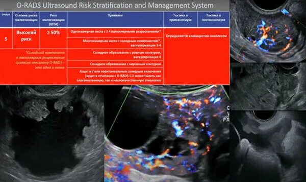 РАДС классификация образований яичников. Киста левого яичника o-rads 3. Классификация o-rads для УЗИ. РАДС классификация образований яичников на УЗИ. O rads 3