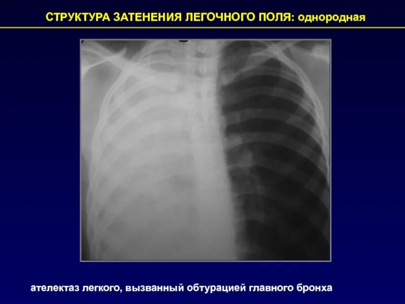 Синдромы затенения легочного поля. Рентгенологические синдромы. Рентгенологические синдромы заболеваний легких. Синдром патологии легочного рисунка. Рентгенологические синдромы легких