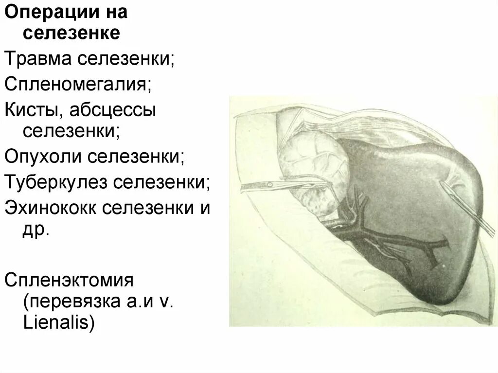 Операции на селезенке. Печень топографическая анатомия и Оперативная хирургия. Операции на селезенке топографическая анатомия.