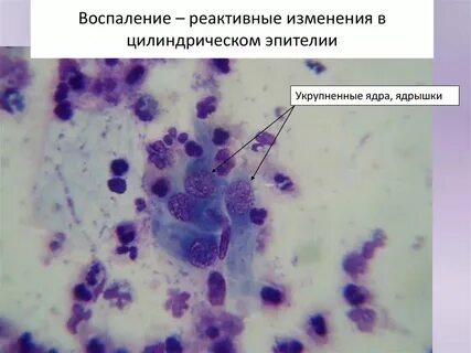 Пролиферация цервикального эпителия