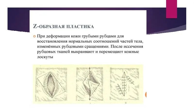 Виды местной пластики. Кожаная пластика местными тканями. Пластика местными тканями на питающей ножке. Пластика ран кожи местными тканями. Кожная пластика презентация.