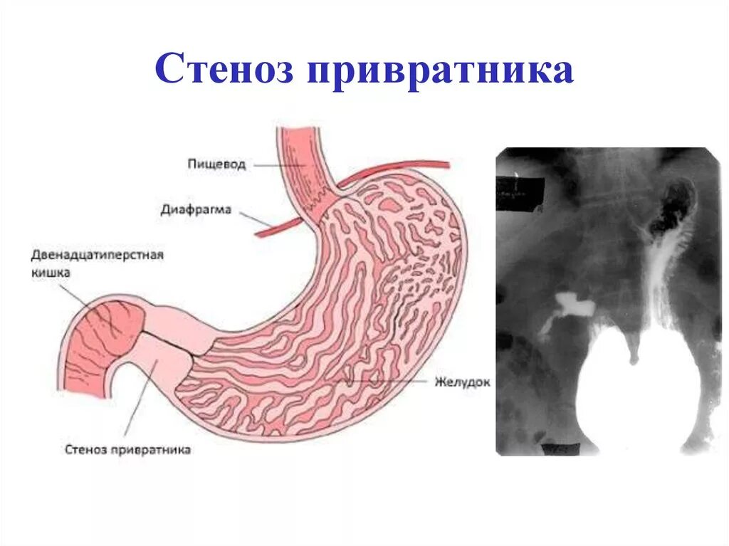 Кто такой привратник. Язвенная болезнь желудка стеноз. Стеноз привратника язвы желудка. Осложнения язвенной болезни двенадцатиперстной кишки. Язвенная болезнь стеноз привратника.