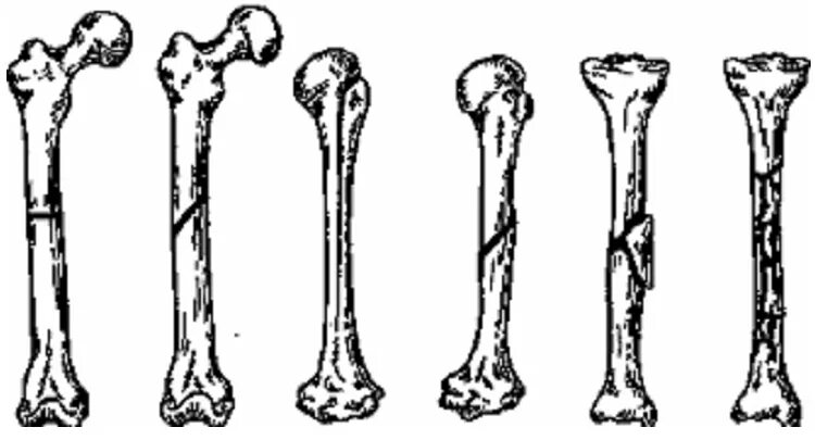 6 трубчатых костей. Поперечный перелом бедренной кости. Классификация переломов трубчатых костей. Классификация смещений костных отломков. Сопоставлени еотломков костей пр переломе.