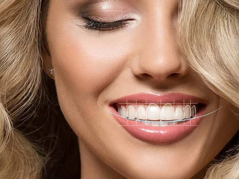 Smile design