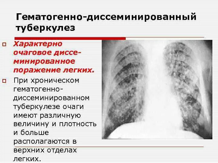 Милиарный диссеминированный туберкулез рентген. Лимфогенно диссеминированный туберкулез рентген. Хронический диссеминированный туберкулез рентген. Диссеминированный туберкулез острый подострый и хронический. Диссеминированное поражение легких