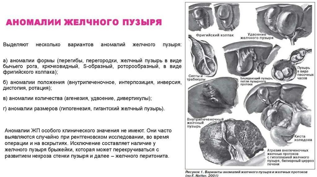 Врожденные аномалии желчного пузыря. Аномалии формы желчного пузыря на УЗИ. Врожденные пороки развития желчного пузыря. Желчный пузырь s-образный формы.