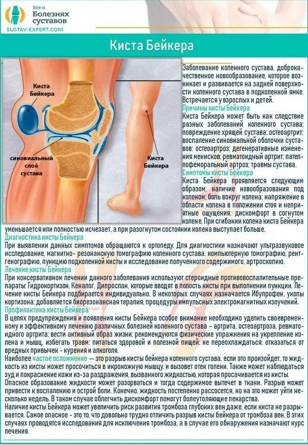 Болит бедро к какому врачу. Ревматоидный коленный сустав: киста Бейкера, сгибательные деформации. Бейкера киста Бейкера коленного сустава.