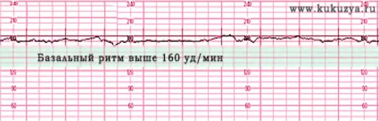 Вариабельность сердечного ритма плода на КТГ. Синусоидальный ритм КТГ. Базальный ритм на КТГ 120. Базальная частота КТГ.