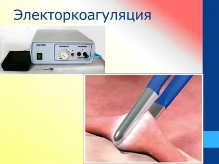 Коагуляция сосудов