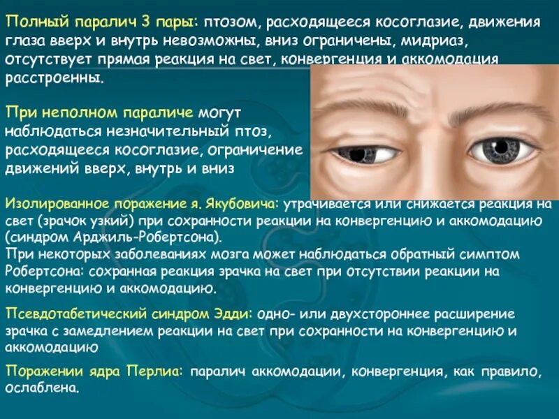 Нарушение движений глазных яблок